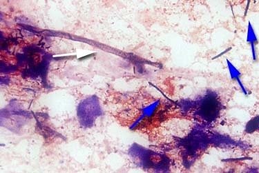 In evidenza numerosi megabatteri (frecce blu). La freccia bianca indica un frammento vegetale. Tampone cloacale, colorazione Gram (Foto: Universit della Georgia)