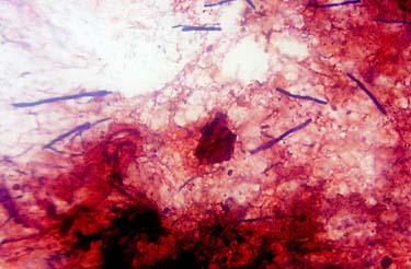 Microfotografia di numerosi megabatteri. Tampone cloacale, colorazione Gram (Foto: Universit della Georgia)